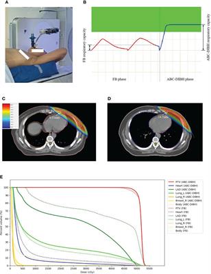 The effect of respiratory capacity for dose sparing in <mark class="highlighted">left-sided breast</mark> cancer irradiation with active breathing coordinator technique